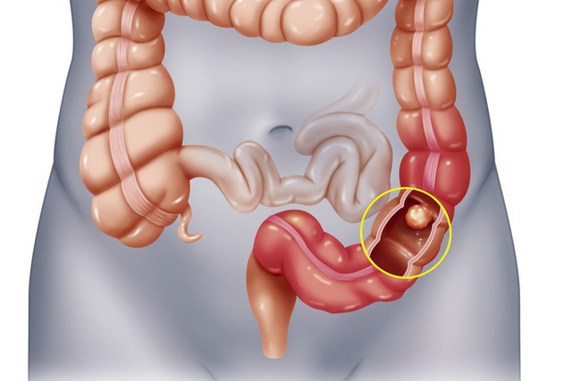 Cùng mắc ung thư, có người chữa khỏi nhưng có người tử vong: Do 3 điểm khác biệt cần biết - Ảnh 3.