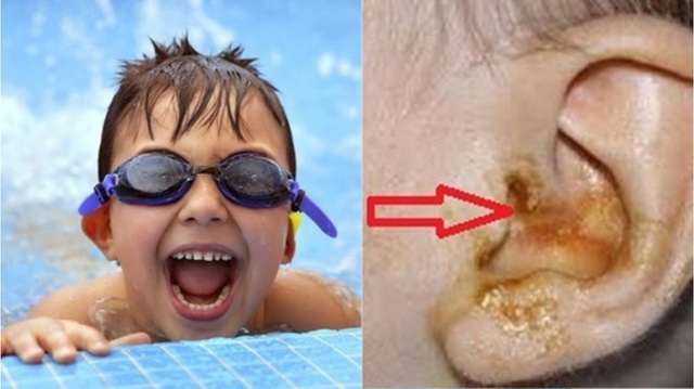 Đau tai dữ dội dù bơi ở bể 5 sao: Bác sĩ chỉ 3 căn bệnh phổ biến do hoá chất bể bơi gây ra - Ảnh 1.