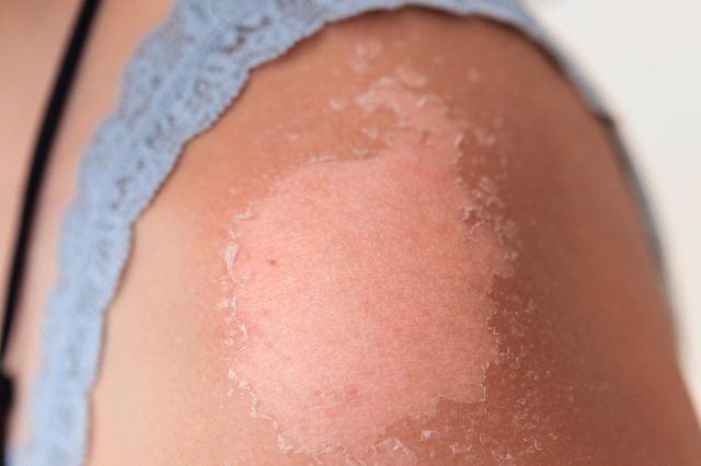 Vết cháy nắng có thể tồn tại bao lâu trên da và biện pháp làm dịu vết cháy nắng, phục hồi da nhanh hơn - Ảnh 2.