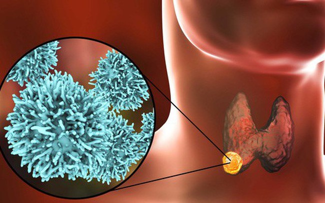 Thấy 5 dấu hiệu này, bạn nên đi khám vì ung thư tuyến giáp đang lớn dần trong cơ thể