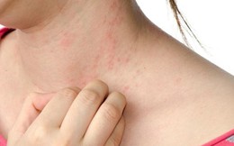 Dị ứng thời tiết vào mùa hè: Bất kể ai cũng có thể gặp phải và những lưu ý từ chuyên gia nhất định không được bỏ qua Dị ứng thời tiết vào mùa hè: Bất kể ai cũng có thể gặp phải và những lưu ý từ chuyên gia nhất định không được bỏ qua