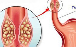 Bí quyết chiến thắng căn bệnh ung thư thực quản của lão nông 64 tuổi, sống hơn 16 năm sau ca phẫu thuật Bí quyết chiến thắng căn bệnh ung thư thực quản của lão nông 64 tuổi, sống hơn 16 năm sau ca phẫu thuật