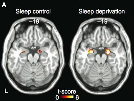 Hình ảnh chụp MRI của não khi bạn hoạt động liên tục không ngủ suốt 16 giờ