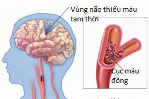 Thiếu máu não cục bộ tạm thời có thể bị nhầm với cơn đau nửa đầu.