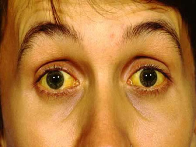 
Tình trạng vàng da, vàng mắt là dấu hiệu dễ nhận thấy của bệnh gan.
