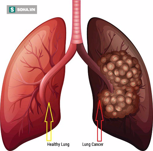 Ung thư phổi gây tử vong số 1: Những dấu hiệu cảnh báo sớm tuyệt đối không nên lờ đi - Ảnh 1.