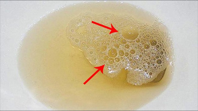 10 bí mật về nước tiểu liên quan đến thận, sức khỏe: Ai cũng nên biết rõ để phòng bệnh tốt