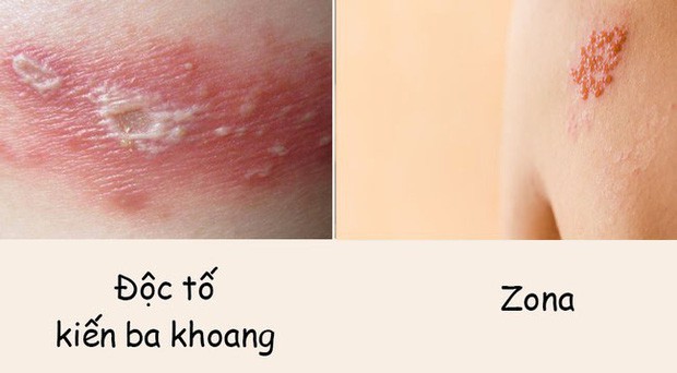Phân biệt vết thương do kiến ba khoang với viêm da do zona để tránh dùng sai thuốc khiến bệnh càng khó chữa - Ảnh 1.