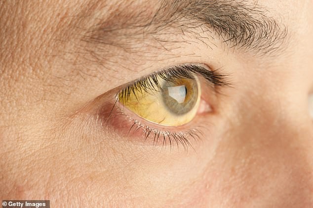 9 dấu hiệu bất thường trên đôi mắt cảnh báo bệnh tật nguy hiểm - Ảnh 3.
