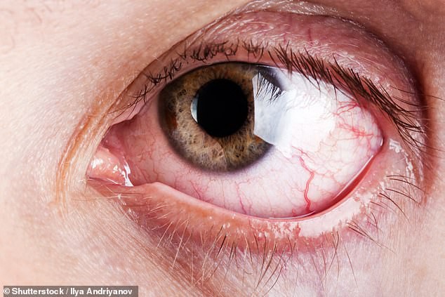 9 dấu hiệu bất thường trên đôi mắt cảnh báo bệnh tật nguy hiểm - Ảnh 4.