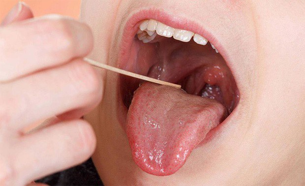 Lưỡi đột nhiên sưng đỏ bất thường có thể là cảnh báo của nhiều vấn đề sức khỏe mà bạn chẳng ngờ đến - Ảnh 6.