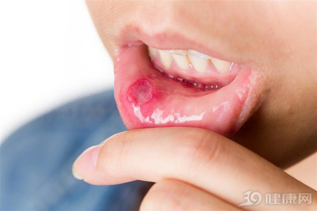 Người đàn ông phải cắt bỏ 1/3 lưỡi do mắc ung thư lưỡi: 2 việc làm xấu nhiều người mắc phải có thể gây ra tình trạng này - Ảnh 3.