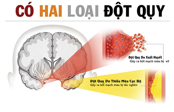 Cấp cứu đột quỵ: Sự sống tính trong từng phút giây - Ảnh 1.