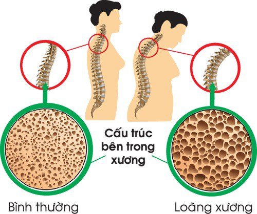 Bác sĩ BV Bạch Mai cảnh báo về căn bệnh giống kẻ trộm sức khỏe thầm lặng: Tiến triển âm thầm , không triệu chứng, người càng lười vận động càng có nguy cơ cao - Ảnh 1.