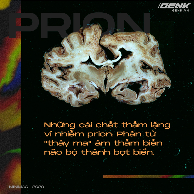 Những cái chết thầm lặng vì nhiễm prion: Phân tử thây ma âm thầm biến não bộ thành bọt biển - Ảnh 1.