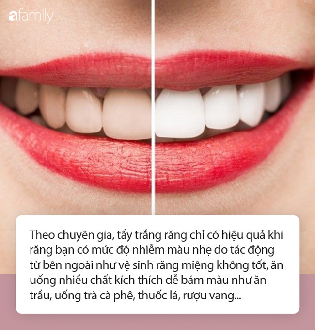Học cách sử dụng hdrogen peroxide để làm trắng răng như trên Tik Tok: Chuyên gia khuyến cáo cần hết sức cẩn trọng! - Ảnh 3. Học cách sử dụng hdrogen peroxide để làm trắng răng như trên Tik Tok: Chuyên gia khuyến cáo cần hết sức cẩn trọng! - Ảnh 3.