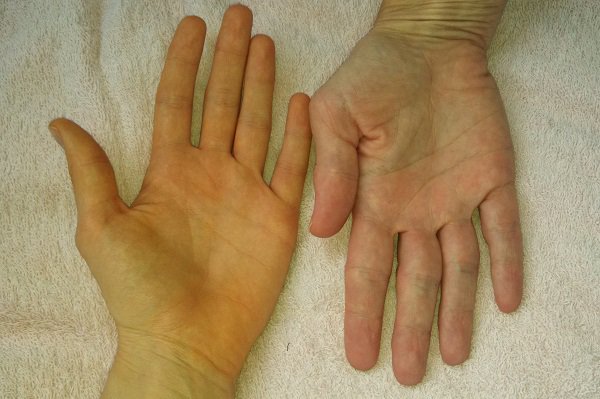 Soi tay chân cũng có thể nhận biết được 5 biểu hiện cảnh báo bạn có nguy cơ mắc ung thư hay không - Ảnh 1.