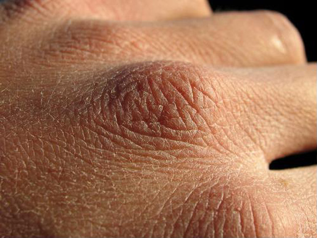 Chuyên gia da liễu tiết lộ 3 bệnh về da thường gặp vào mùa đông, muốn phòng tránh phải làm đủ 10 điều quan trọng - Ảnh 1.