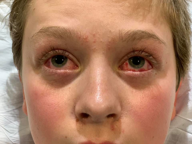 Hình ảnh cậu bé 11 tuổi mắt chuyển màu đỏ máu đáng sợ nhưng chân lại có màu xanh do mắc Covid-19 gây lo ngại - Ảnh 1.