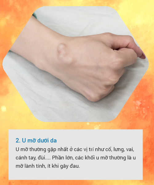 BS khuyến cáo về các loại u vùng cổ tay hay gặp: Đừng bỏ qua vì đó có thể là dấu hiệu cảnh báo bệnh nguy hiểm - Ảnh 2.