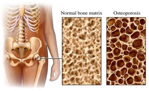  1/3 phụ nữ trên 50 tuổi mắc bệnh này: 8 biện pháp cần dự phòng - Ảnh 1.