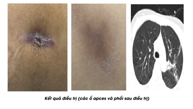 Nữ bệnh nhân mắc bệnh Whitmore ở Phú Thọ được cứu sống kịp thời - Ảnh 2.