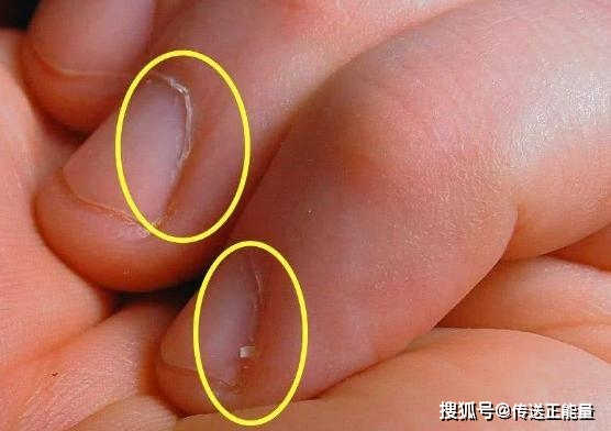 3 biểu hiện trên móng tay đang cảnh báo bạn bị thiếu máu, không phát hiện ra sớm để bồi bổ thì cơ thể sẽ sinh bệnh - Ảnh 1.