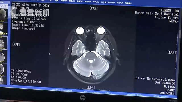 Người phụ nữ phát hiện khối u ác tính trong ống tai, bác sĩ cảnh báo thói quen ngoáy tai quá đà có thể kích hoạt tế bào ung thư - Ảnh 1.