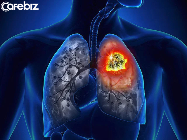 Có 3 điểm bất thường ở TAY và BẢ VAI cảnh báo sớm ung thư phổi, đi chụp chiếu ngay mới mong tăng tỉ lệ sống! - Ảnh 2.