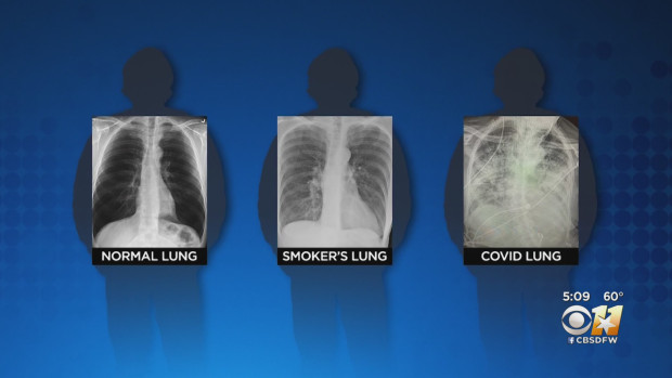 BS so sánh 3 lá phổi: Bệnh nhân Covid-19 có hậu quả tổn thương ...