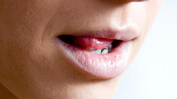  3 dấu hiệu bất thường trong khoang miệng ngầm cảnh báo bệnh ung thư lưỡi đang tiến triển - Ảnh 3.