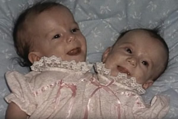  Bị chẩn đoán khó sống sót, cặp chị em sinh đôi dính liền chỉ có 2 chân khiến thế giới kinh ngạc với cuộc sống và diện mạo sau hơn 30 năm - Ảnh 1.