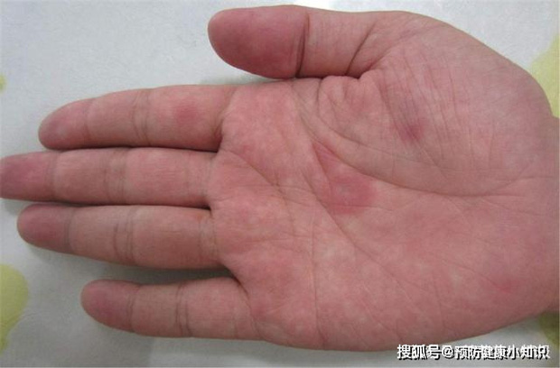 Người sở hữu lá gan khỏe mạnh sẽ có 5 biểu hiện trên bàn tay, nếu bạn có đủ cả thì xin chúc mừng - Ảnh 4.