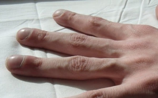 4 triệu chứng trên ngón tay cho thấy chất độc trong cơ thể gần như bùng phát, hãy nhanh chóng đi tầm soát ung thư gan, phổi trước khi quá muộn - Ảnh 1.