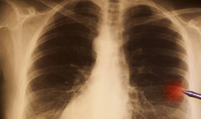 Bệnh nhân ung thư phổi giai đoạn cuối vẫn sống tiếp 10 năm: Bác sĩ ...
