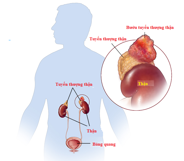 Người đàn ông có khối u hiếm gặp trên cả 2 thận: Cảnh giác triệu chứng đau hông lưng - Ảnh 1.