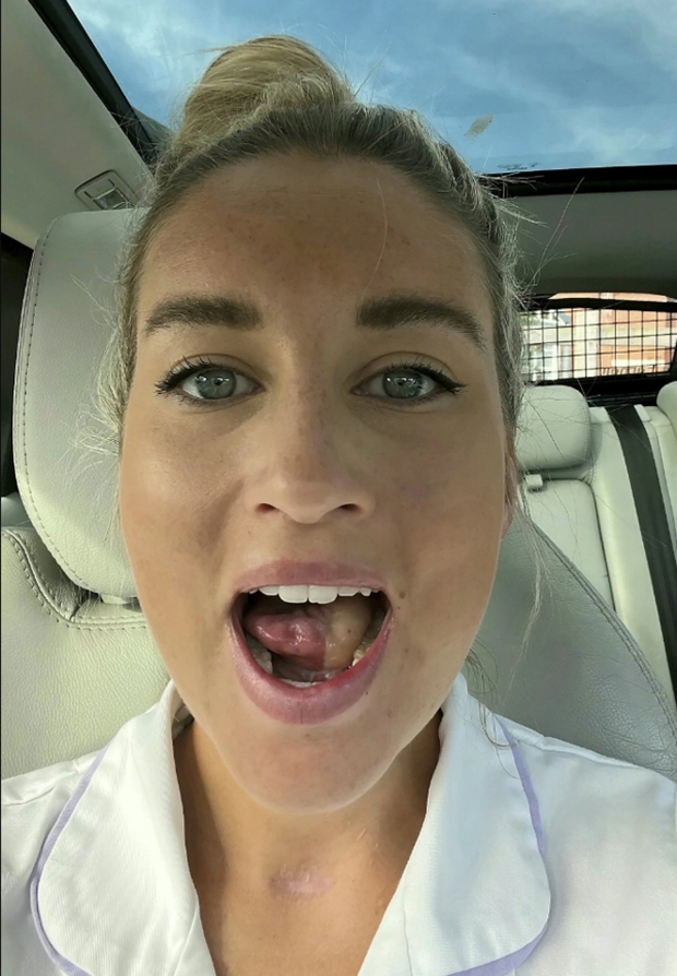 Nhiệt miệng mãi không khỏi, cô gái 27 tuổi đi khám phát hiện ung thư miệng phải cắt bỏ một nửa lưỡi - Ảnh 2.