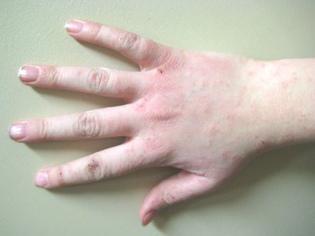  Người có lượng đường trong máu cao thường có 3 dấu hiệu bất thường này ở bàn tay - Ảnh 1.