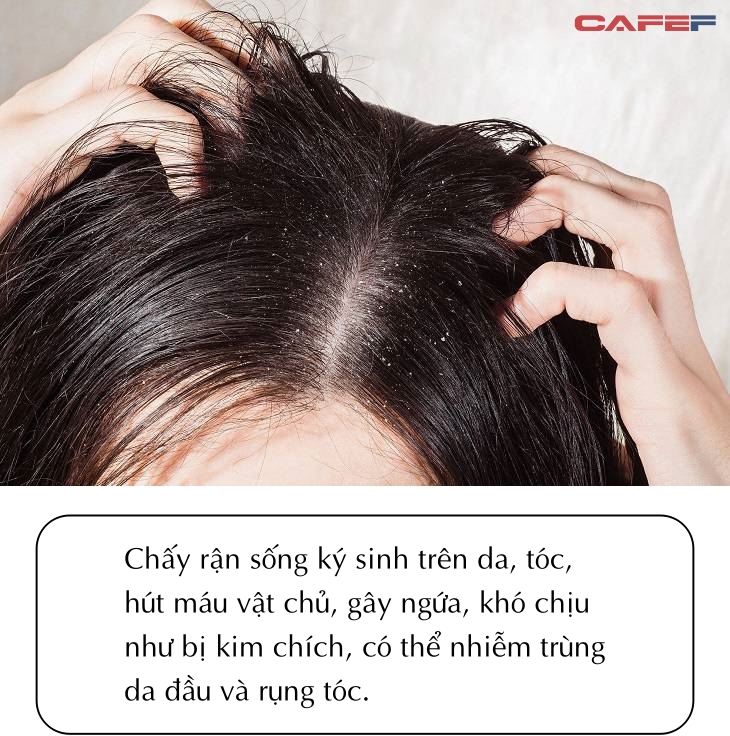 Sáng ngủ dậy thấy TÓC có 3 hiện tượng: Một THỦ PHẠM nguy hiểm đang lẩn trốn  trong da đầu, cẩn thận không rụng tóc, lở loét cả đầu
