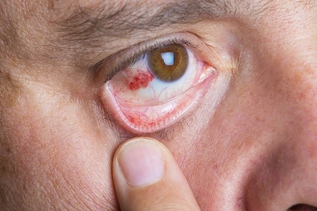 Sai lầm khi sử dụng điều hòa trong mùa hè dẫn đến đột quỵ mắt, nặng nhất có thể gây mù lòa: Chú ý điều này để bảo vệ thị lực và sức khỏe - Ảnh 1.