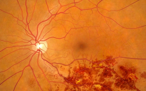 Sai lầm khi sử dụng điều hòa trong mùa hè dẫn đến đột quỵ mắt, nặng nhất có thể gây mù lòa: Chú ý điều này để bảo vệ thị lực và sức khỏe - Ảnh 3.