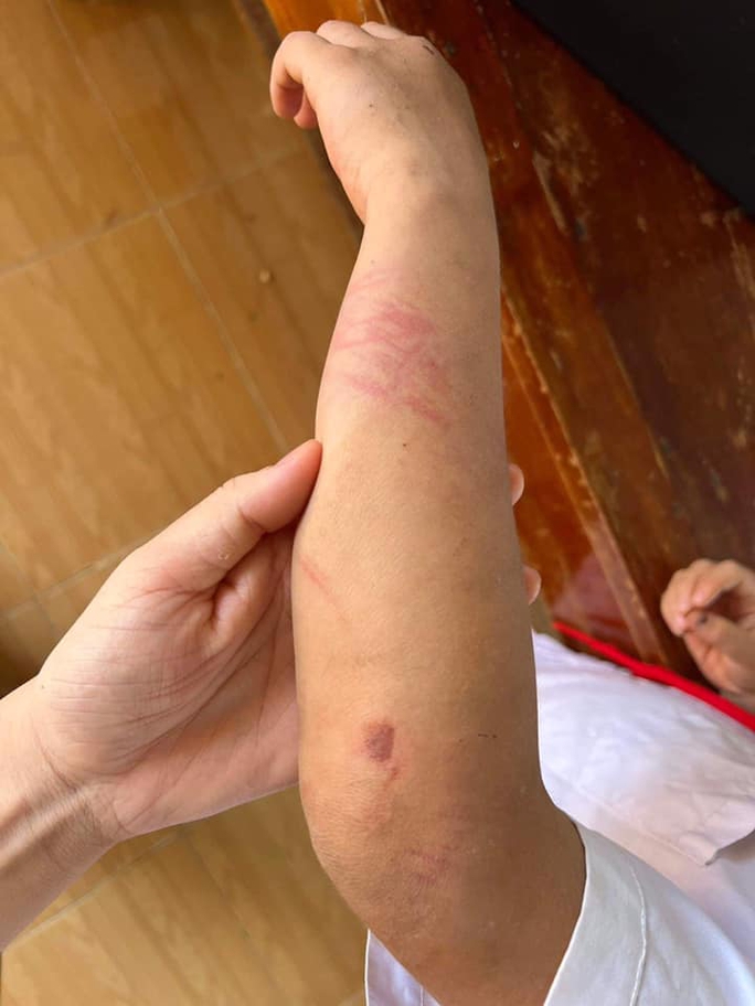 Cháu bé 9 tuổi bị bà và cha đánh đập dã man - Ảnh 6. Cháu bé 9 tuổi bị bà và cha đánh đập dã man - Ảnh 6.