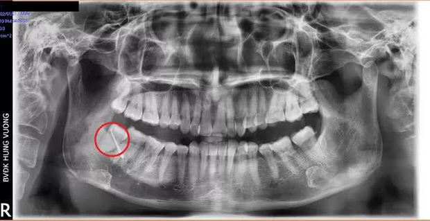 Hy hữu: Bệnh nhân bị... thủng má do biến chứng răng số 48 mọc lệch - Ảnh 2.