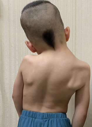 Bé trai 6 tuổi bị biến dạng vẹo lệch cột sống - lời cảnh báo cho các bậc cha mẹ - Ảnh 2.