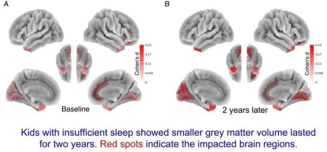 Đại học Y khoa của Mỹ phát hiện: Trẻ ngủ không đủ 9 giờ mỗi đêm sẽ có ít chất xám hơn - Ảnh 1.