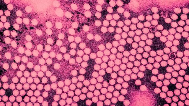 Mỹ: Bang New York tuyên bố tình trạng thảm họa khẩn cấp vì bệnh bại liệt - Ảnh 1.