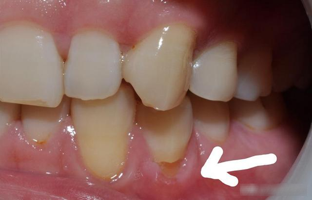 Răng vỡ rụng từng mảng vì cách đánh răng sai nhiều người mắc - Ảnh 1.