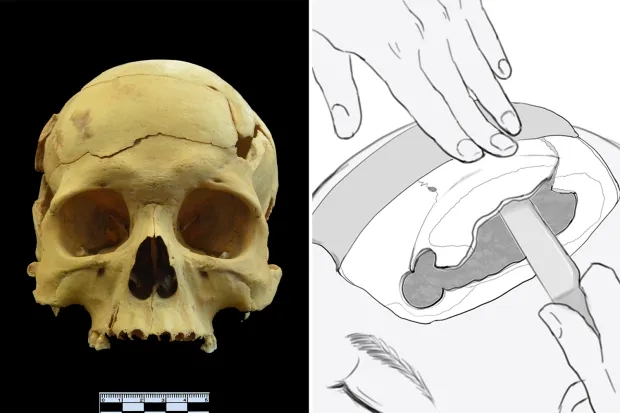 Phát hiện ca phẫu thuật kỳ lạ cách đây 2.700 năm, Hoa Đà đòi “mổ sọ” cho Tào Tháo hóa ra là có thật? - Ảnh 4.