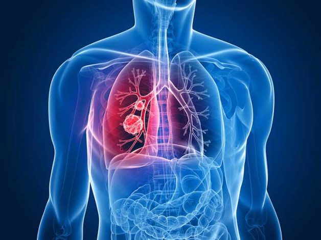Không ốm sốt, chỉ đau thắt lưng, người phụ nữ đến BV Bạch Mai khám bất ngờ phát hiện ung thư phổi đã di căn: Cảnh báo 3 dấu hiệu quan trọng tuyệt đối không được bỏ qua - Ảnh 1.