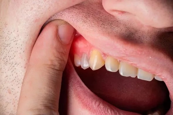 3 màu sắc ở răng là dấu hiệu cảnh báo căn bệnh có dẫn đến rụng răng, thậm chí ung thư - Ảnh 3.